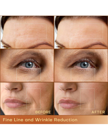 MLAY Máquina de Radiofrecuencia Facial RF Profesional 25W/50W