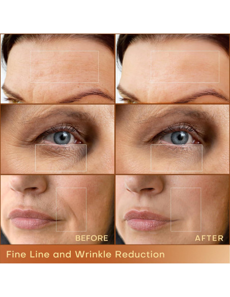 MLAY Máquina de Radiofrecuencia Facial RF Profesional 25W/50W