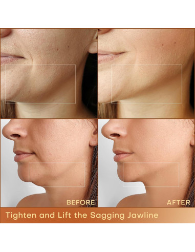 MLAY Máquina de Radiofrecuencia Facial RF Profesional 25W/50W