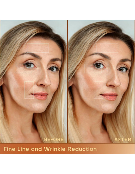 MLAY Máquina de Radiofrecuencia Facial RF Profesional 25W/50W