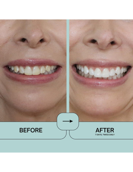 Prostrips - 28 Tiras Blanqueadoras Dentales - 12 Tonos Más Blancos