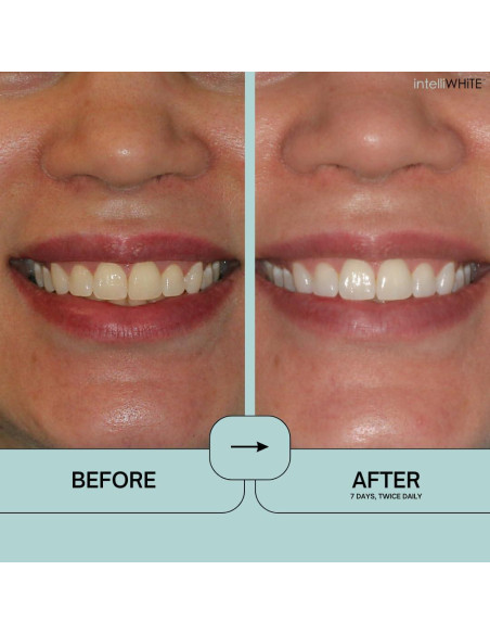 Prostrips - 28 Tiras Blanqueadoras Dentales - 12 Tonos Más Blancos