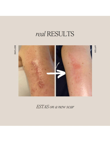 Set de Crema para Cicatrices ESTAS Beauty - 3 Productos Efectivos