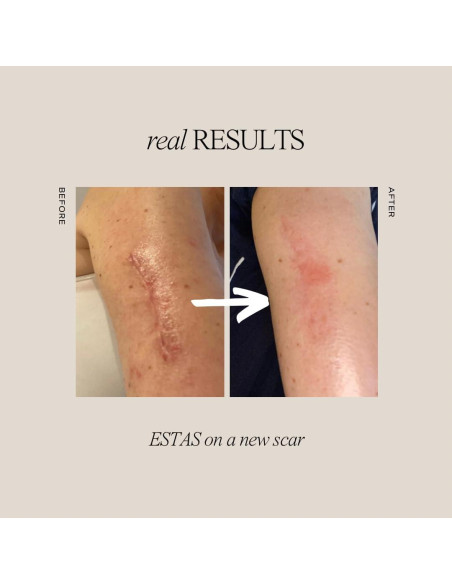 Set de Crema para Cicatrices ESTAS Beauty - 3 Productos Efectivos