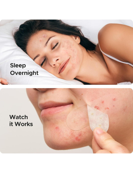 Parches Hidrocoloides TKTK 45x45 mm para Granitos - 120 Piezas