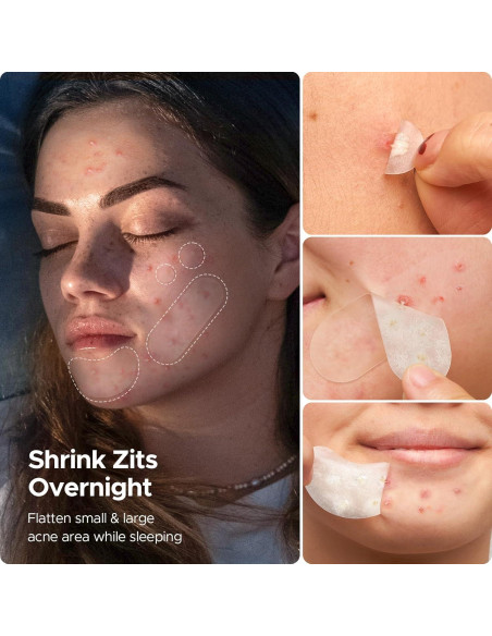 Parches para Granos LitBear - 400 Unidades, 5 Tamaños