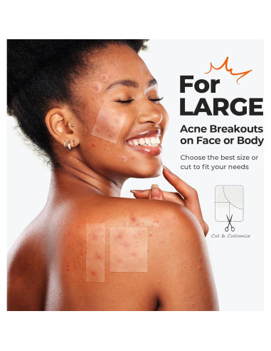 Parches para Acné TKTK Hidrocoloide Grande 92 Piezas 5 Tamaños