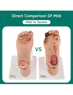 Conjunto de Ulcera del Pie Diabético Ultrassist - Modelo Clínico 2