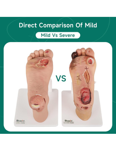 Conjunto de Ulcera del Pie Diabético Ultrassist - Modelo Clínico