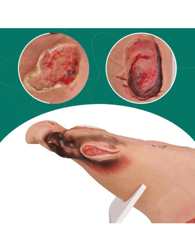 Conjunto de Ulcera del Pie Diabético Ultrassist - Modelo Clínico