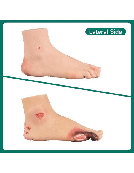 Conjunto de Ulcera del Pie Diabético Ultrassist - Modelo Clínico