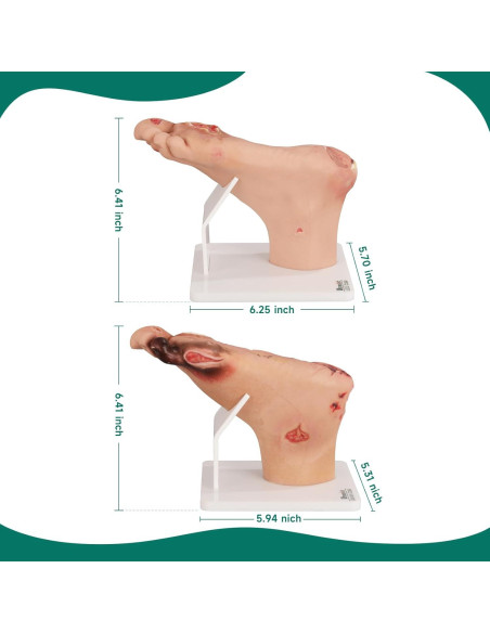Conjunto de Ulcera del Pie Diabético Ultrassist - Modelo Clínico