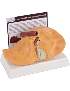 Modelo de Hígado Graso Alcohólico Simedutech 25.9x17x16cm 2