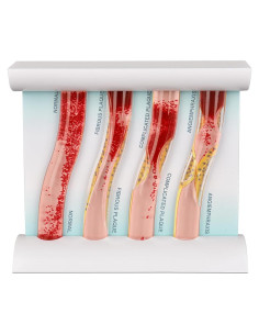 Modelo Vascular SimCoach LDL para Educación Médica 4 Etapas