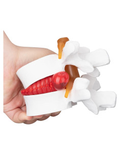 Modelo Anatómico de Herniación de Disco Lumbar 1.5X