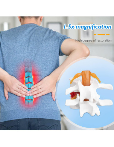 Modelo Anatómico de Herniación de Disco Lumbar 1.5X