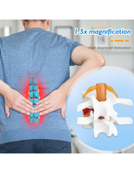 Modelo Anatómico de Herniación de Disco Lumbar 1.5X