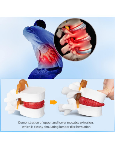 Modelo Anatómico de Herniación de Disco Lumbar 1.5X