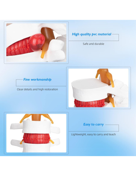 Modelo Anatómico de Herniación de Disco Lumbar 1.5X