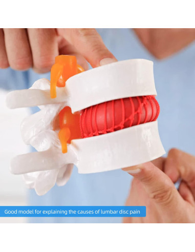 Modelo Anatómico de Herniación de Disco Lumbar 1.5X