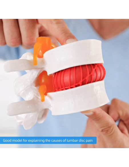 Modelo Anatómico de Herniación de Disco Lumbar 1.5X