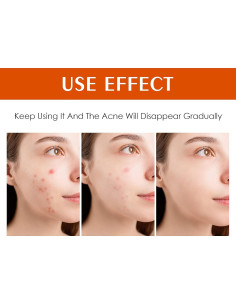 Crema Tratamiento Acné Localizado 30g - Hidratante Anti-acné 2