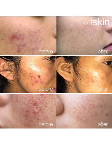 Suero Z-Blast Kidskin para Acné Facial 29.57 ml - Vegano