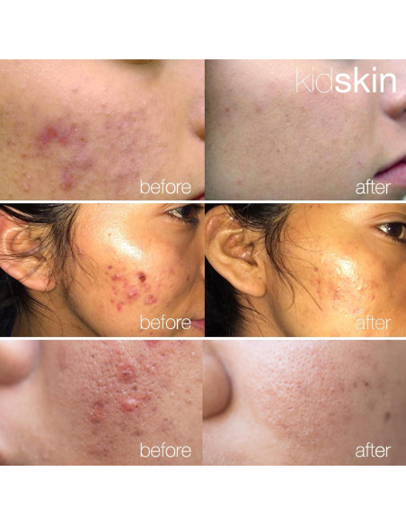 Suero Z-Blast Kidskin para Acné Facial 29.57 ml - Vegano