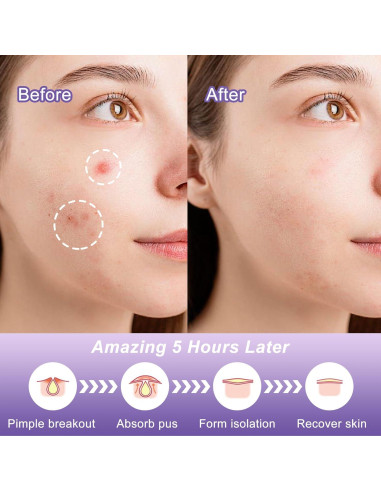 Parche para Acné CELECARE - Hidrocoloide 30 Unidades (2 Paquetes)