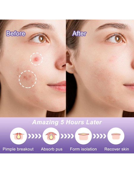 Parche para Acné CELECARE - Hidrocoloide 30 Unidades (2 Paquetes)