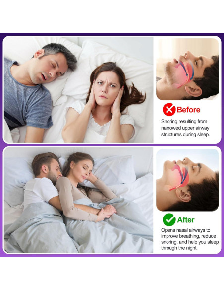 Tiras Nasales ZenithHome para Ronquidos - 100 Unidades