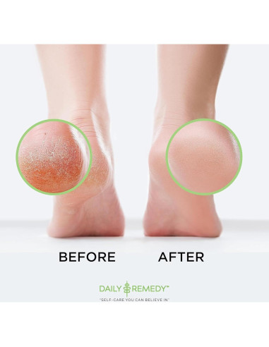 Gel Removedor de Callos Daily Remedy 226.8g - Pies Suaves