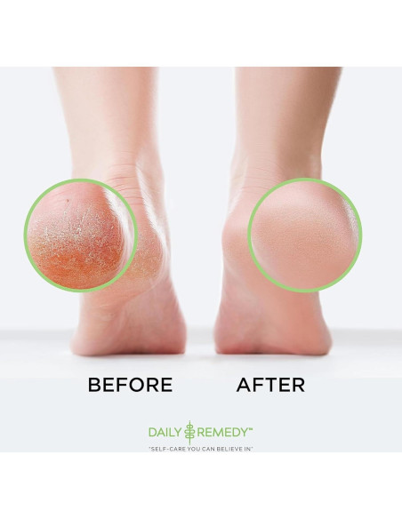 Gel Removedor de Callos Daily Remedy 226.8g - Pies Suaves