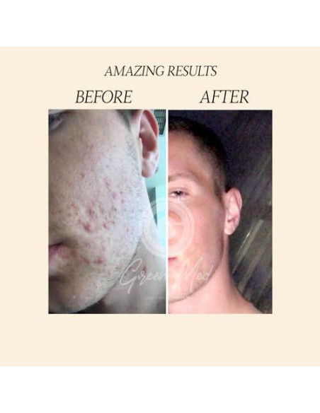 Jabón Negro Africano Green Med 79.9g - Limpieza Profunda y Regeneración