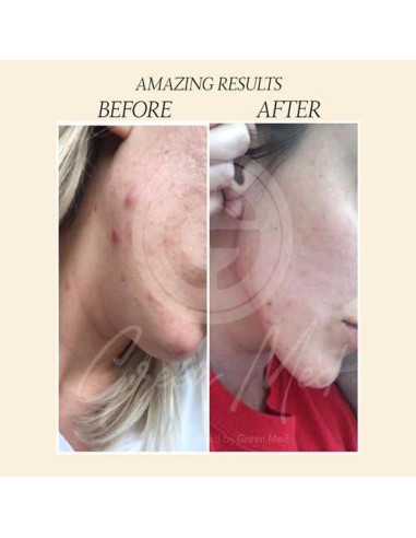 Jabón Negro Africano Green Med 79.9g - Limpieza Profunda y Regeneración