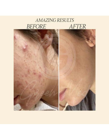 Jabón Negro Africano Green Med 79.9g - Limpieza Profunda y Regeneración