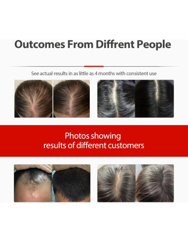 Gorro Láser Carviki 2026 para Crecimiento del Cabello