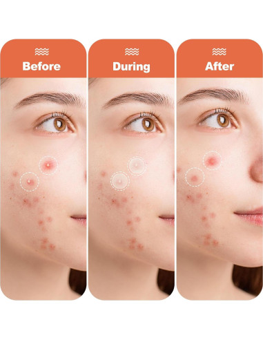 Parche Hidrocoloide para Acné Cabiuty - 68 Parches de 3 Tamaños