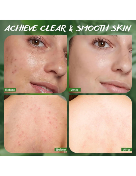 Jabón de Árbol de Té 3x100g - Limpieza Facial y Corporal