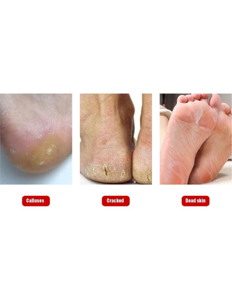 Kit de Lima para Pies Dioche con 11 Cuchillas Exfoliantes