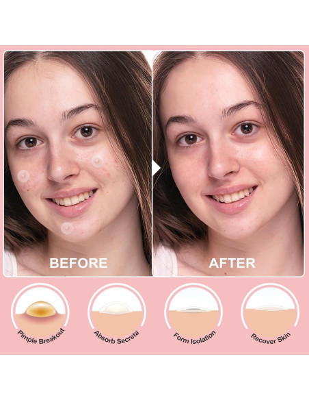 72 Parches Hidrocoloides para Acné Invisibles - Cuidado Facial