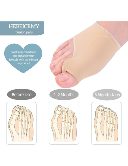 Corrector de Juanetes Beige HEBEICRMY - 5 PCS Gel Alivio Corrector de Juanetes Beige HEBEICRMY - 5 PCS Gel Alivio