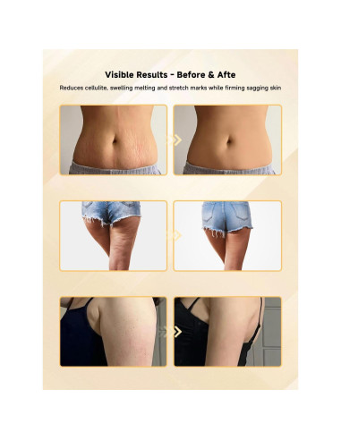 Masajeador Anticelulitis Nenrent 6103 - Drenaje Linfático y Calor