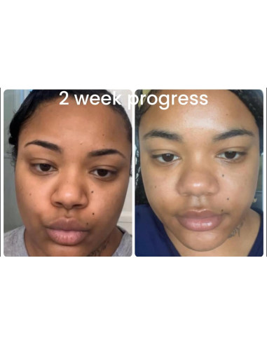 Jabón Aclarador de Cúrcuma y Ácido Kójico 113g - Hecho a Mano