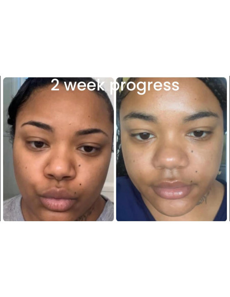 Jabón Aclarador de Cúrcuma y Ácido Kójico 113g - Hecho a Mano