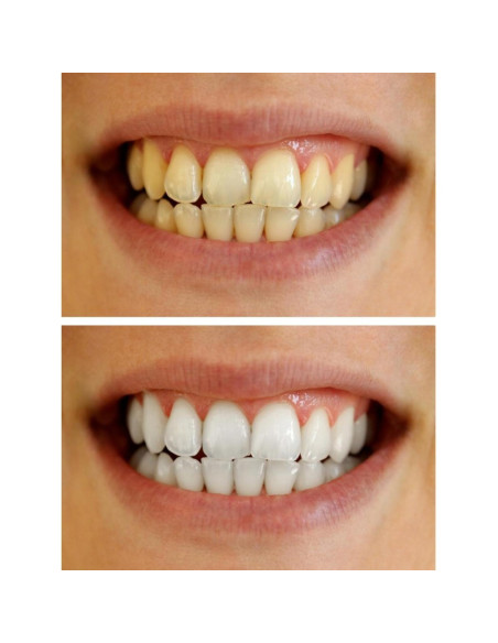 Gel Blanqueador Dental 22% Bleach Pro - 10 Jeringas de 3ml