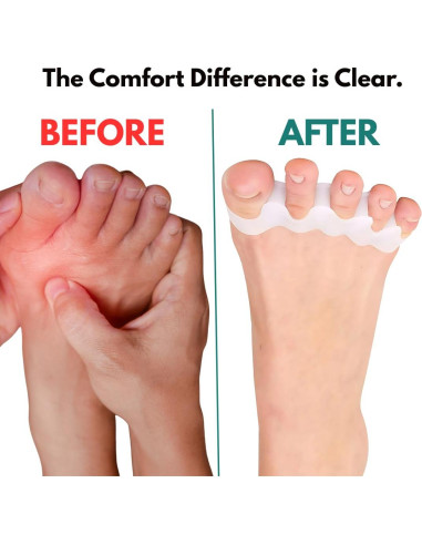 Separadores de Dedos de Silicona ZEYNOA - 6 Pcs Alivio Juanetes