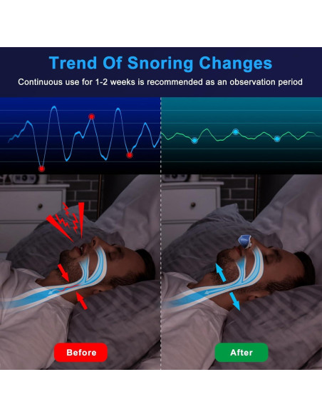 Dispositivo Antisnoring LUNIA Azul - Solución para Ronquidos