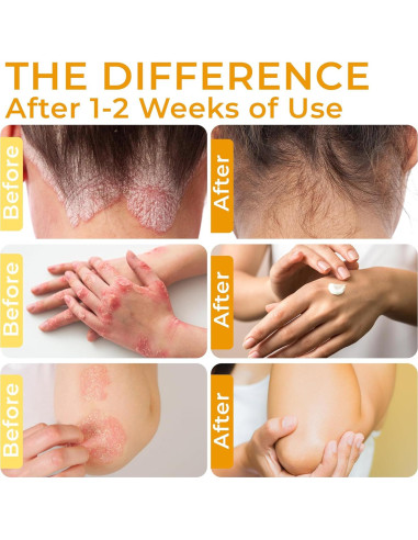 Crema para Psoriasis Remixidil 381g - Alivio Picazón e Irritación