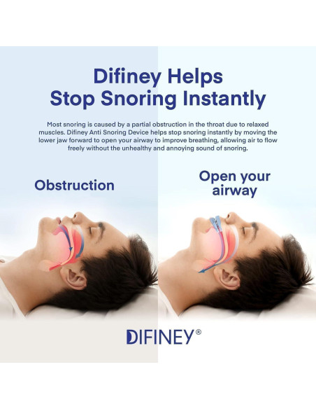 Protector Bucal Anti Ronquidos Fissiontech Azul - Aprobado FDA